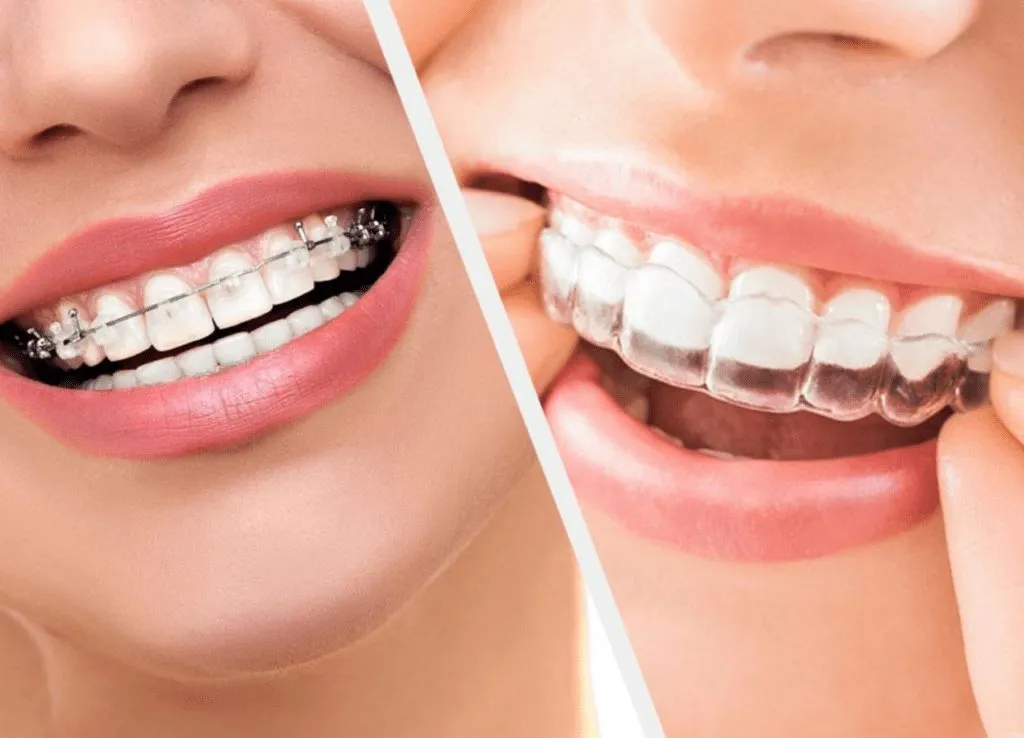 Orthodontic Treatment Service - Braces and aligners at Klinik Pergigian Razz Johor Bahru